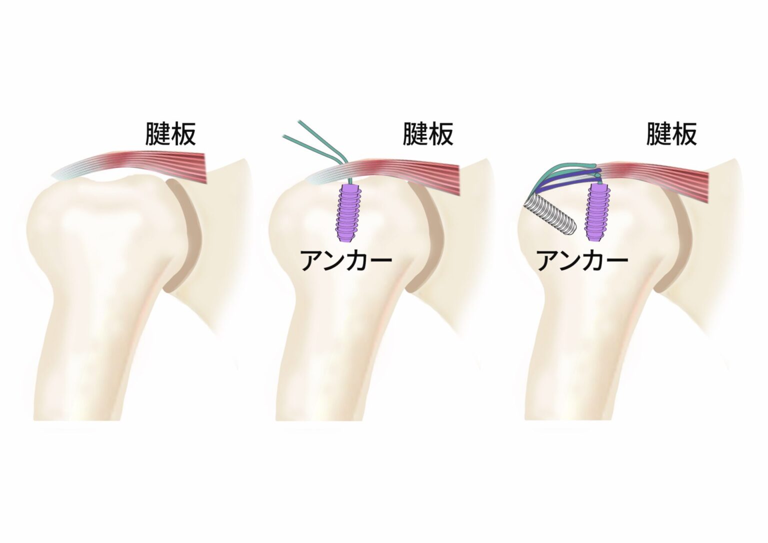 腱板損傷とは | 三重郡川越町の整形外科|にしはら整形外科スポーツクリニック
